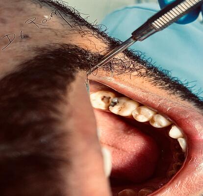 dental veneers in mussafah